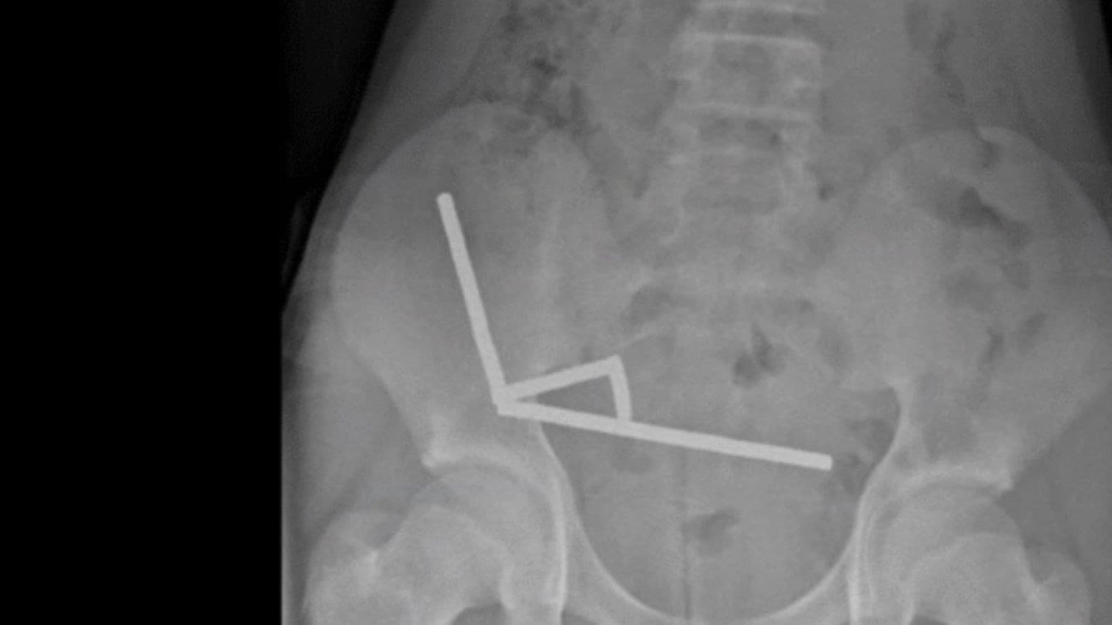 13さいの男の子、たくさんの強いじしゃくをのみこんで手じゅつ