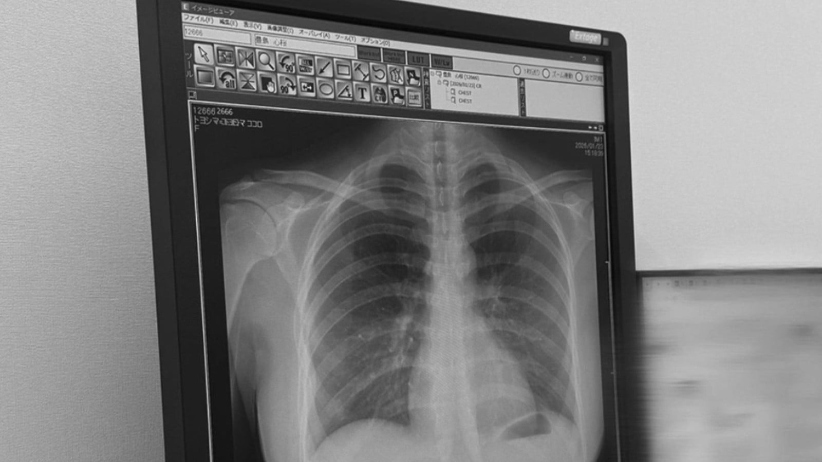 22歳のモデル、豊島心さんがX線写真をSNSで公開して話題に