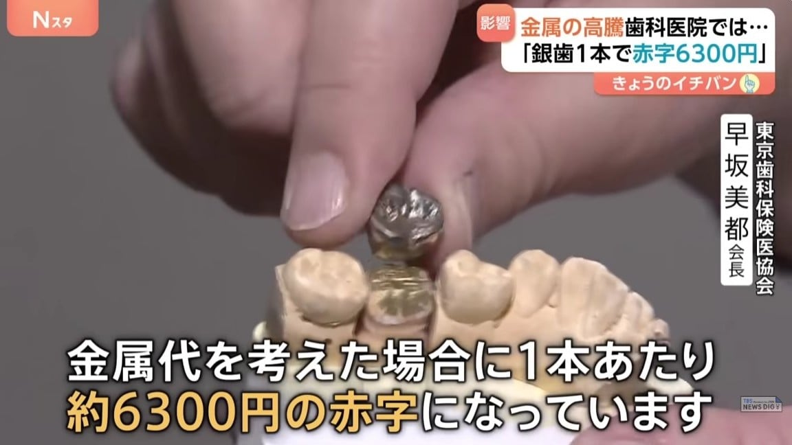 金や銀のねだんが上がって、歯医者さんがこまっています
